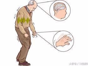 Run tay có phải bệnh Parkinson?